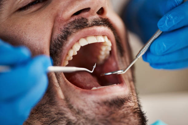Best Knocked-Out Tooth (Avulsed Tooth) Treatment in Muscoy, CA